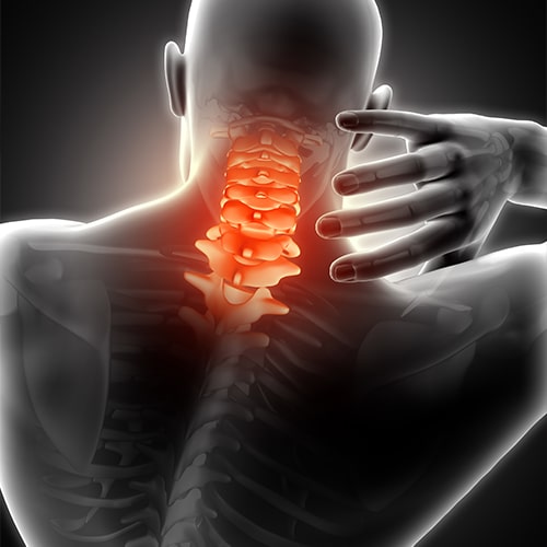 Cervical spondylitis