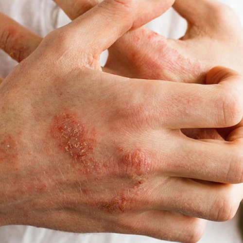Eczema