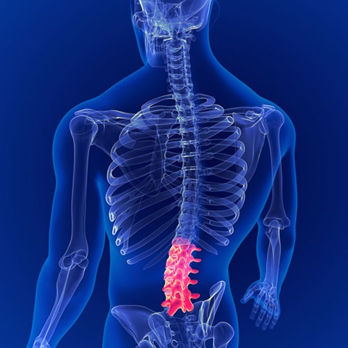 Lumbar spondylitis