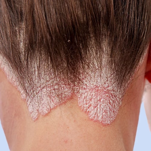 Psoriasis treatment by dr.balaji