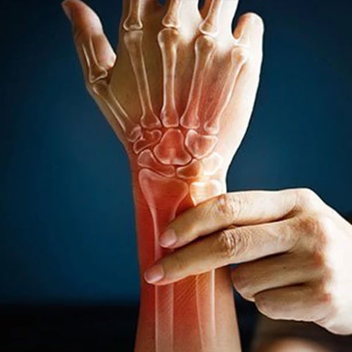 Rheumatoid arthritis